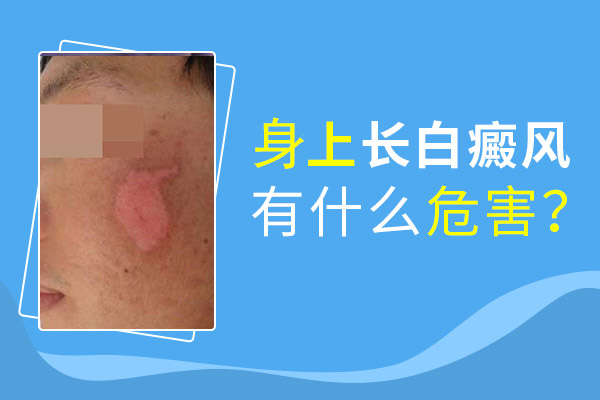 白癜風患者懷孕有影響嗎